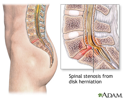 Peripheral artery disease and intermittent claudication