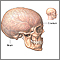Craniotomy - series