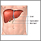 Liver transplant - series