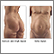 Liposuction - series - Indications