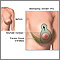 Breast lift (mastopexy) - series - Incisions