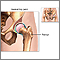 Hip joint replacement - series - Normal anatomy