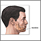 Chin augmentation - series